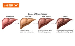 小牛洞察 | 肝纤维化：被忽视的 “肝脏预警信号”，可逆但不容拖延