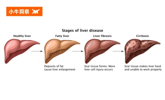 小牛洞察 | 肝纤维化：被忽视的 “肝脏预警信号”，可逆但不容拖延