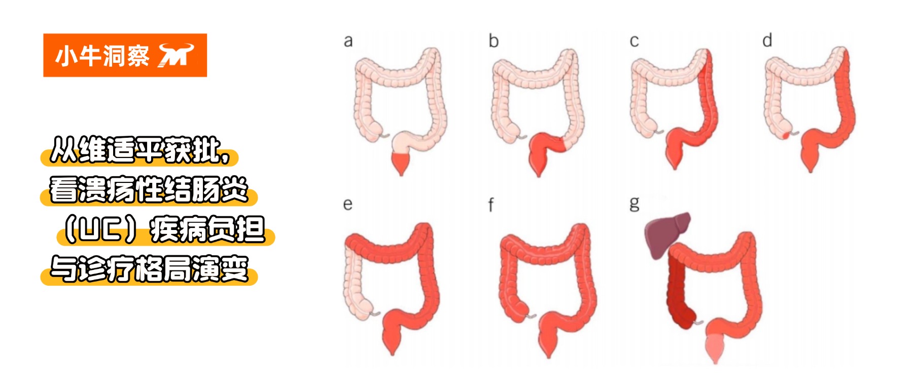 小牛洞察 | 从维适平获批，看溃疡性结肠炎（UC）疾病负担与诊疗格局演变
